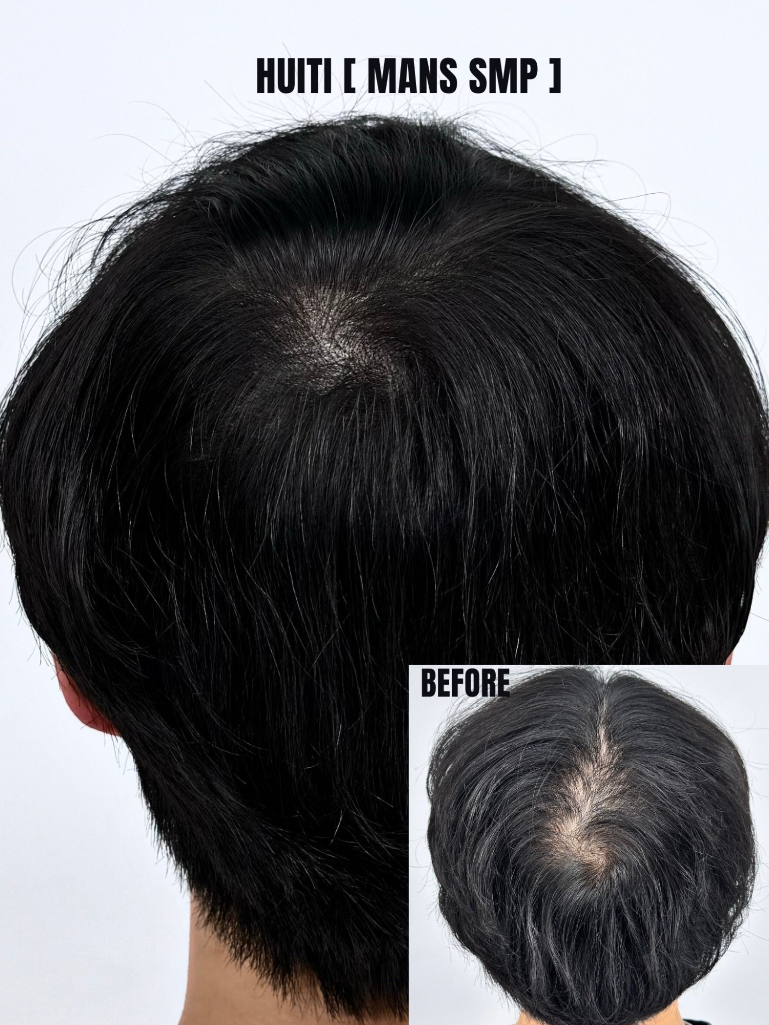 남자 두피숱채움