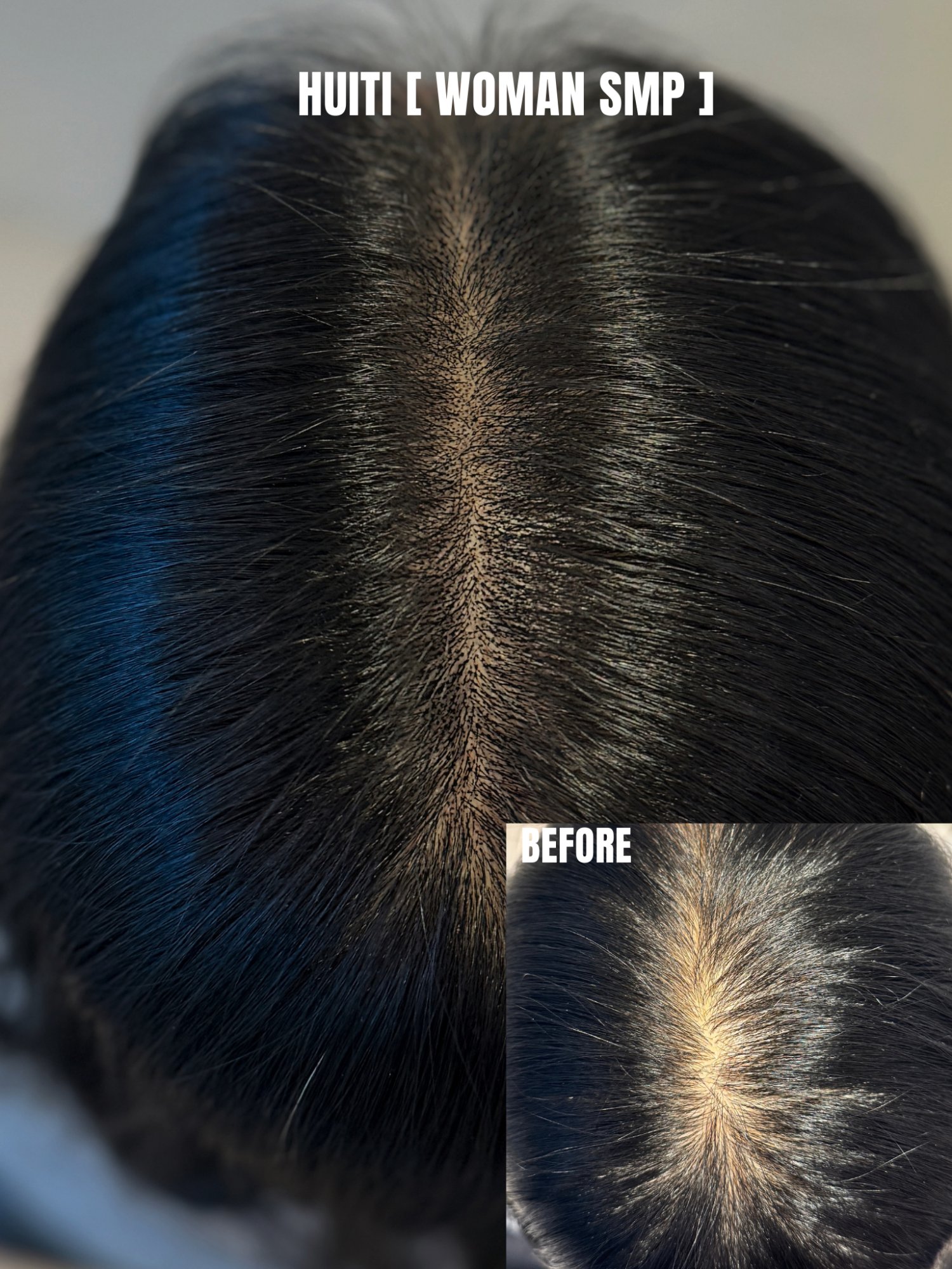 여자 두피숱채움